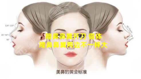 隆鼻鼻翼开刀 假体隆鼻鼻翼两边不一样大